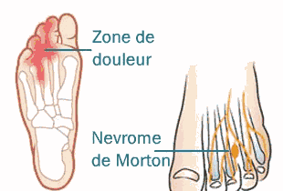 Névrome de Morton Causes Symptomes Traitements naturels