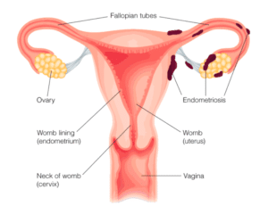 Endométriose, formation de tissu endométrial en dehors de la cavité utérine