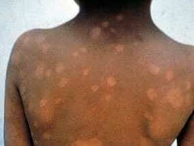 La lèpre, appelée aussi maladie de Hansen, infection contagieuse due au bacille Mycobacterium leprae