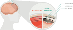 Méningite, inflammation des enveloppes protectrices de l'encéphale et de la moelle épinière