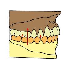 Occlusion dentaire, la façon dont s'alignent et se positionnent les dents du haut par rapport à celles du bas en position statique