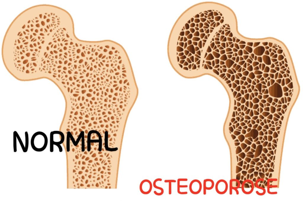 Ost Oporose Causes Sympt Mes Quels Traitements Naturels