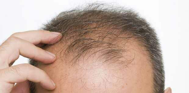 Perte de cheveux pour les hommes  Causes et soins