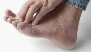 Manifestations des pieds d'athlète : Desquamation, rougeur, prurit, ...