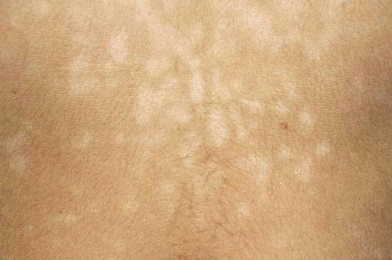 Pityriasis versicolor : Dermatose à traiter soigneusement