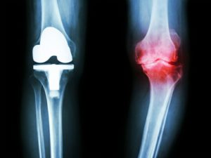 Arthrose, maladie se manifestant par la dégénérescence des cartilages