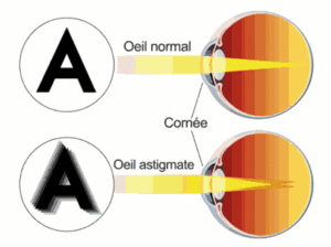 L'astigmatisme se traduit par une déformation au niveau de la courbure de la cornée, causant des troubles visuels