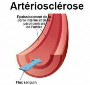 L'artériosclérose désigne le durcissement des artères dû au vieillissement