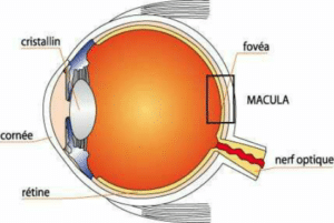 DMLA, ou dégénérescence maculaire liée à l'âge, pathologie de l'oeil qui se traduit par la baisse de l'acuité visuelle