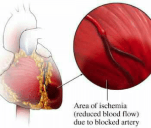 Ischémie, c'est la baisse ou l'interruption du flux sanguin vers un organe ou une partie du corps