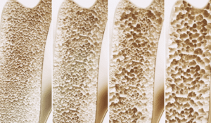 L'astragale prévient le développement d'une ostéoporose