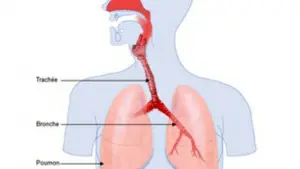 Coqueluche, infection des voies respiratoires due à la présence de bactérie de type Bordetella