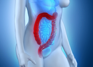 Symptômes de la rectocolite hémorragique : diarrhées, douleurs abdominales, présence de sang et de mucus, ...