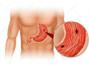 L'ulcère désigne l'altération de la couche superficielle de la peau ou des muqueuses entrainant la formation d'une plaie. Ici c'est le cas de l'estomac.