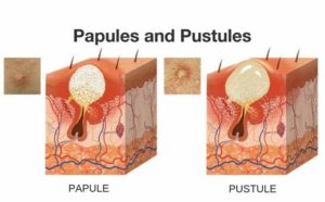 papules